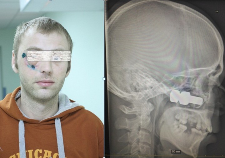 В Красноярском крае отлетевший от грузовика болт пробил череп прохожего