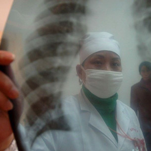 Заболеваемость и смертность от туберкулеза снизились в Прибайкалье