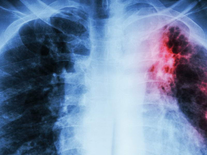 Жительницу Боханского района заставили лечиться от туберкулеза