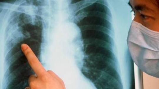 В Иркутской области заболеваемость туберкулезом превышает российскую в два раза