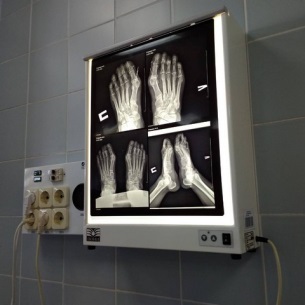 Деформацию стопы начали лечить в областной больнице в Иркутске
