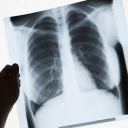 Треть больных туберкулёзом в Чунском районе отказывается от лечения
