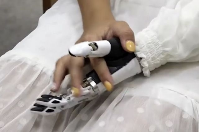 19-летней иркутянке установили  бионический протез кисти