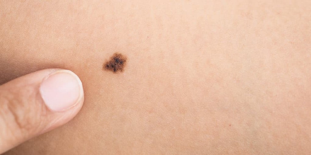Онколог объяснил, почему у женщин рак кожи выявляется в три раза чаще