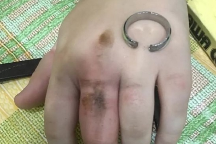 В Ангарске сотрудники МЧС спасли палец 14-летней девочке