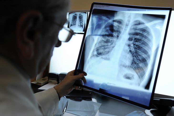 В 2021 году в Иркутской области снизилась заболеваемость туберкулезом на 9,8%